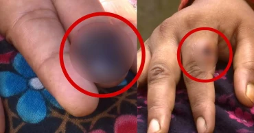 রংপুরে বিরল রোগে আক্রান্ত দুই শতাধিক মানুষ, দেখা দিয়েছে আতঙ্ক