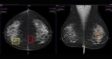স্তন ক্যান্সার শনাক্তে ভুমিকা রাখতে পারে এআই: গবেষণা