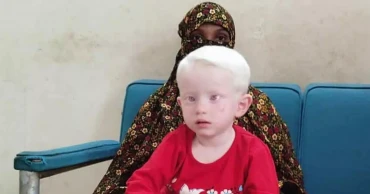 DNA test to establish parentage of albino baby rejected by father in Jashore