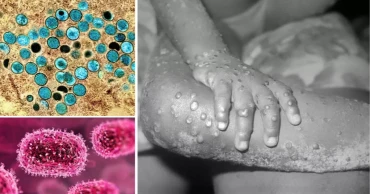 What is Mpox? How does it affect people?