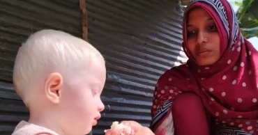 Man divorces wife over albino baby in Jashore; mother, child struggle to survive