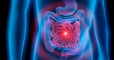 Australian researchers develop AI tool to predict bowel cancer relapse