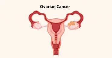 75% of women in middle-income countries at risk of ovarian cancer: Cancer BD Chairman