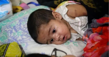 10 die of measles, similar symptoms in 24 hours: DGHS