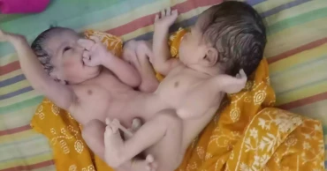 Conjoined twins born in Chandpur, referred to DMCH