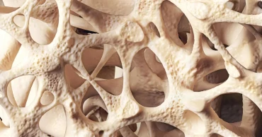 Osteopenia quietly weakening bones of millions worldwide