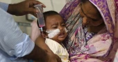 সিলেটে হামের উপসর্গে আরও ৩ শিশুর মৃত্যু, প্রাণহানি বেড়ে ১৬৮