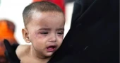 হামের উপসর্গ নিয়ে আরও ৯ শিশুর মৃত্যু