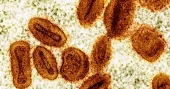 US health officials report 1st case of new strain of mpox in a traveler