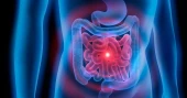 Australian researchers develop AI tool to predict bowel cancer relapse