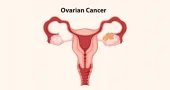 75% of women in middle-income countries at risk of ovarian cancer: Cancer BD Chairman