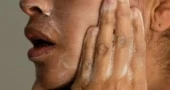 Adult acne is common, but effective treatments are available