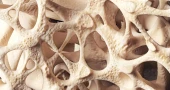 Osteopenia quietly weakening bones of millions worldwide