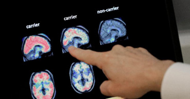 Drug can curb dementia's delusions, researchers find