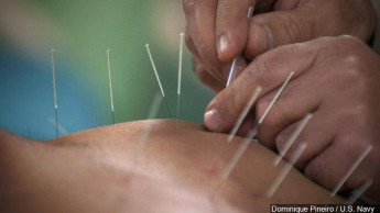 Medicare moving toward covering acupuncture for back pain